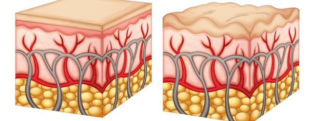 affetta da cellulite