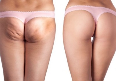 rimedi-cellulite-naturali-400x280